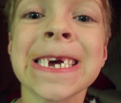 boy with missing teeth; gap looks like a Tetris shape